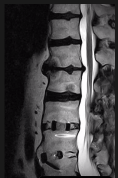 What the heck is a “schmorl&nbsp;node”?
