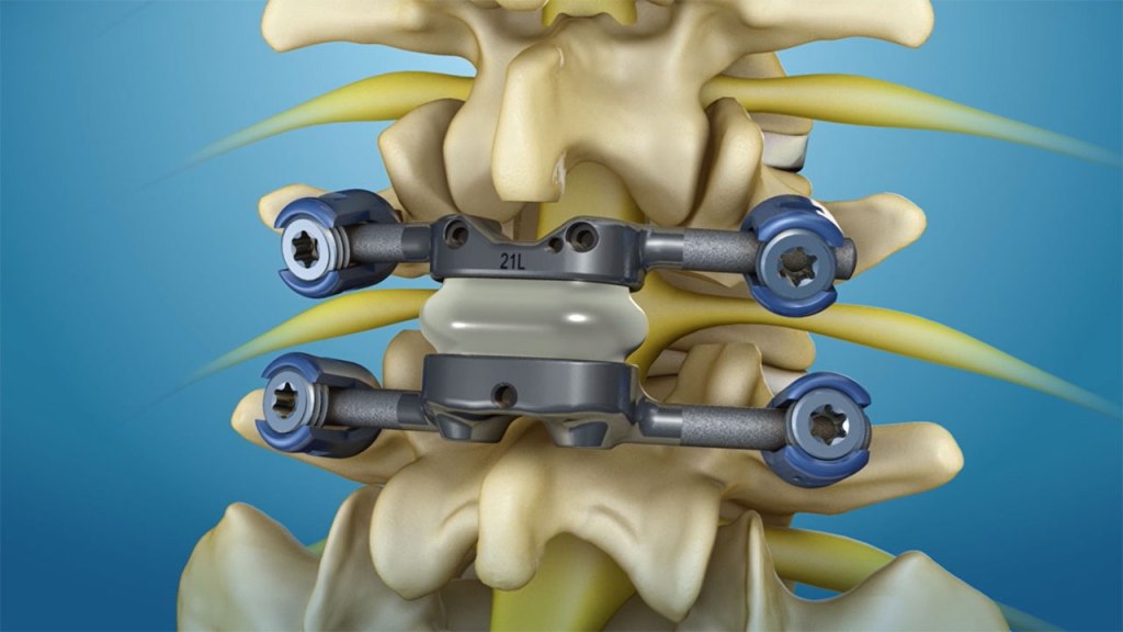 Spinal Non-Fusion Devices Market Poised for&nbsp;Growth
